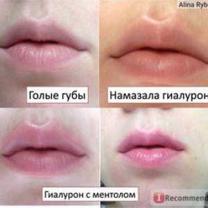 Acid hialuronic pentru buze: efecte și recenzii