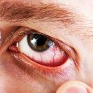 Diclofenac picături pentru ochi: instrucțiuni de utilizare, preț