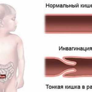 Invaginarea intestinului la un copil - ce este?