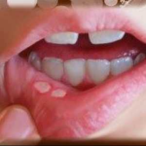 Răni în gură și cauze de tratament