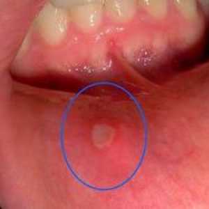 Ulcerații în gură: cauze, simptome, tratament și prevenire