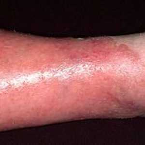 Eczema la etapa inițială: tratament și fotografii