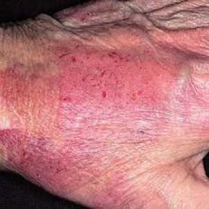 Eczemă pe mâini: tratament și fotografii ale simptomelor