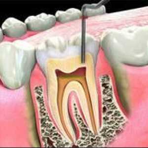Endodontic stomatologie în stomatologie: ce este?
