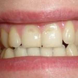 Eroziunea smalțului dinților: cauze, simptome, tratament