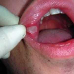 Cum se tratează inflamația mucoasei orale: mijloace și metode de tratament