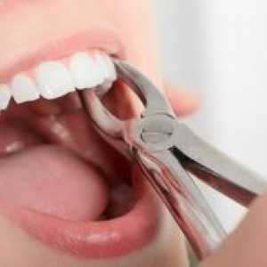 Cum se îndepărtează rădăcina dintelui