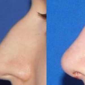 Cum se efectuează rinoplastia pe vârful nasului?
