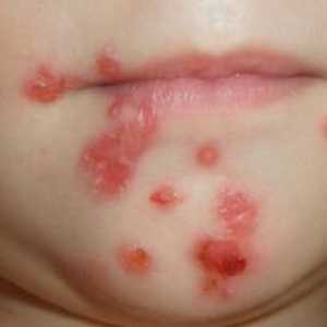Cum se vindecă streptoderma la copii: fotografii și tipuri de infecții