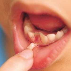 Cum să rupi un dinte copilului de la un copil în mod corect și fără durere