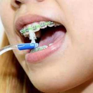 Ce fel de bretele sunt pentru dinți și cum le pun