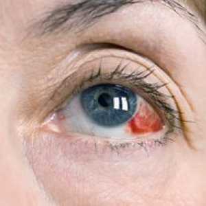 Iodură de potasiu: instrucțiuni pentru utilizarea picăturilor de ochi iod