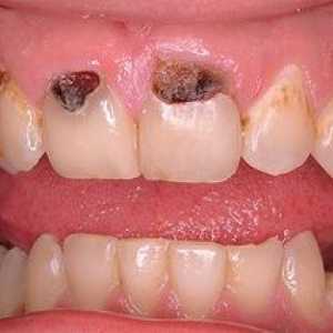 Carii dinților anteriori: cauzele și tratamentul bolii