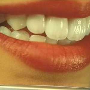 Cerul dinți: ce este, avantajele coroanelor ceramice