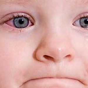 Conjunctivita la copii - cum se trateaza boala la un copil?