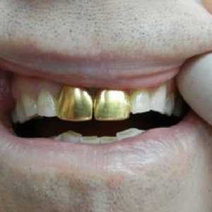 Coroane pe dinți: tipuri principale și caracteristicile acestora