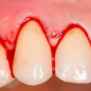 Sângerarea gingiilor: cauze, simptome și tratament