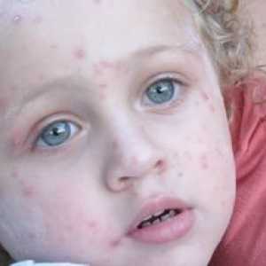 Tratamentul herpesului la copii, foto al manifestărilor externe ale patologiei