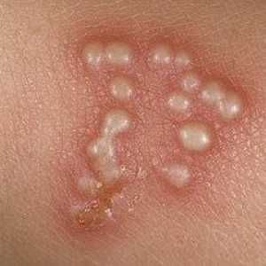 Tratamentul și prevenirea herpesului pe picioare