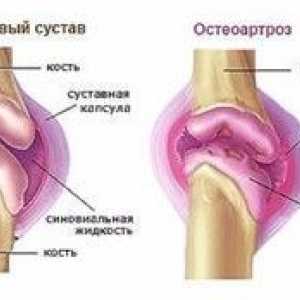 Tratamentul osteoartritei genunchiului de gradul 2
