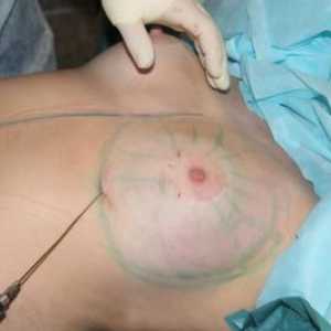 Lipofillingul glandelor mamare: caracteristici ale operației
