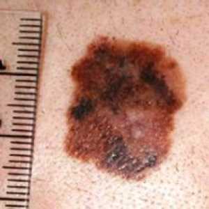 Melanomul în stadiul inițial: tratamentul și fotografiile unei tumori canceroase