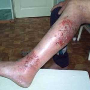 Eczemă microbiană: cauze, simptome, tipuri și metode de tratament