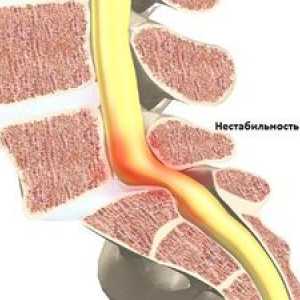 Instabilitatea coloanei vertebrale cervicale: tratament și simptome