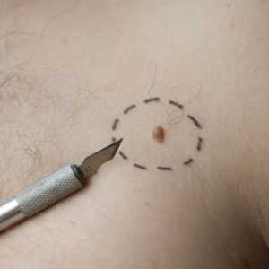 Neoplasme pe piele: fotografii, tipuri și metode de tratament