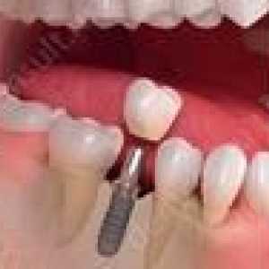 Implantarea imediată a dinților: prețurile și descrierea metodei