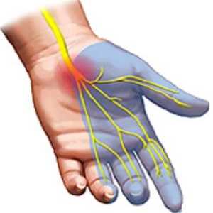 Amorțirea degetelor pe timp de noapte: cauzele bolii și tratamentul acesteia