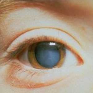 Cataractă complicată a ambilor ochi: ce este această patologie?