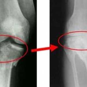 Principalele metode de tratare a gonartrozei articulației genunchiului de gradul III