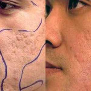 Caracteristicile dermabraziunii laser și mecanice a feței
