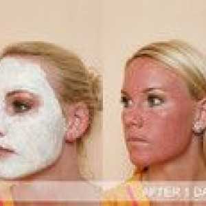 Caracteristicile procedurii pentru peelingul feței medial