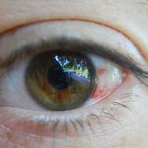 Ce poate sparge vasele de sânge în ochi?