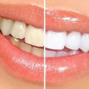 Albirea dinților alb uimitor: caracteristicile procedurii