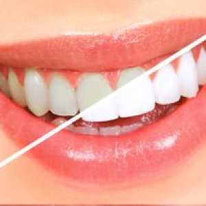 Albirea dinților cu peroxid de hidrogen la domiciliu