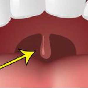 Umflarea palatinei în gât și de la care se poate mări