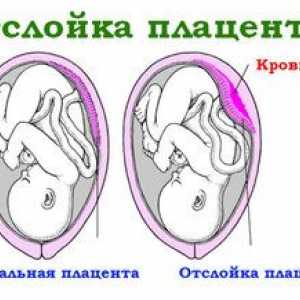 Abrupția placentară la începutul sarcinii