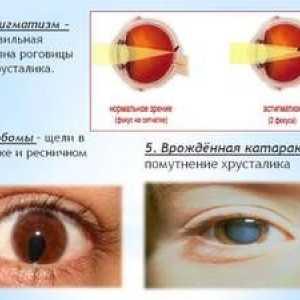 Patologia de vedere redusă la copii: astigmatism, ce este?