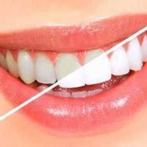 Plăci pentru albirea dinților: indicații și contraindicații