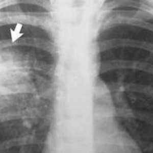 Pneumonie pe raze X: semne de boală la raze X