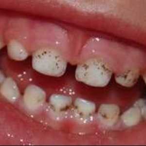 De ce apar puncte negre pe dinți și cum pot fi tratate?