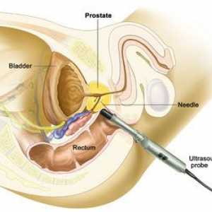 Pregătirea hipertiroidismului de prostată și modul de analiză