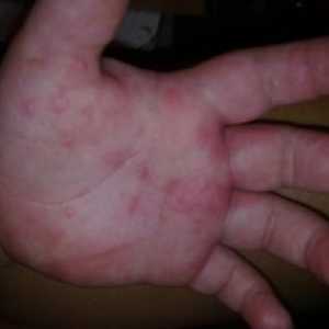 Cauze de mâncărime pete roșii pe mâini