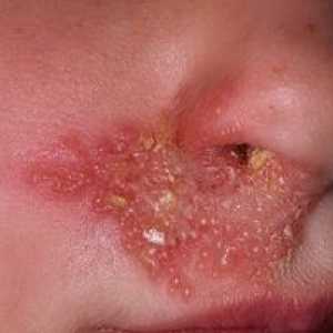 Cauzele și tratamentul herpesului pe față