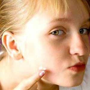 Cauze și tratament al acneei pe obrajii femeilor