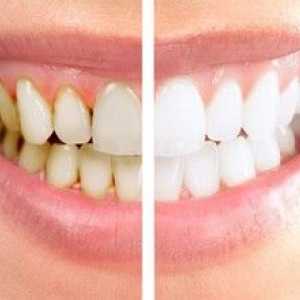 Curățarea dentară profesională în stomatologie: tipuri și descriere