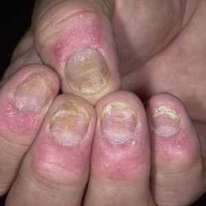 Psoriazisul unghiilor: simptome, cauze, tratament și fotografii